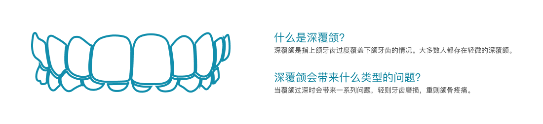 深覆颌介绍