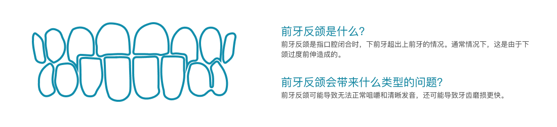 前牙反颌介绍