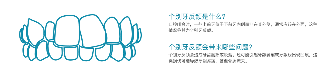 个别牙反颌介绍