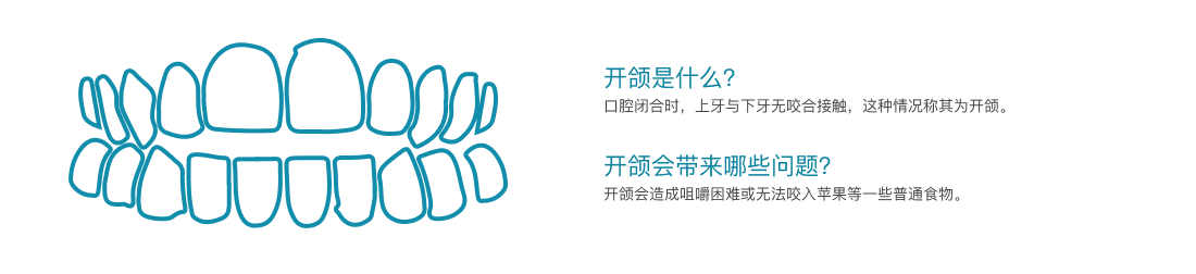 开颌介绍