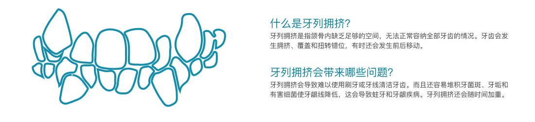 牙列拥挤介绍