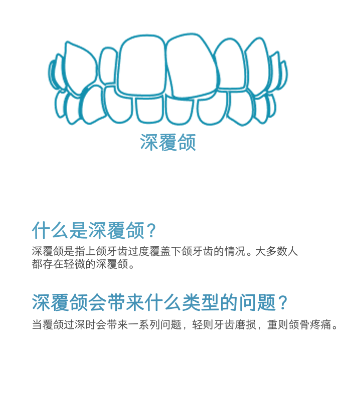 深覆颌介绍