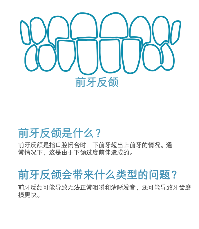 前牙反颌介绍