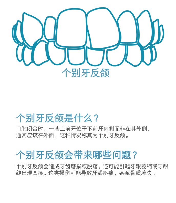 个别牙反颌介绍
