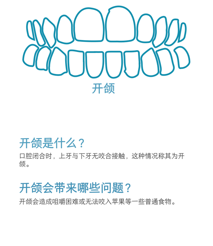 开颌介绍