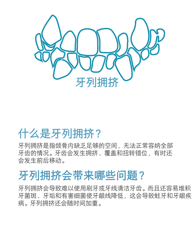 牙列拥挤介绍